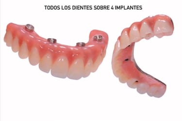 All on 4 dental implants