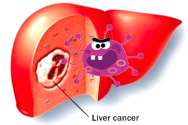 Liver tumour in picture