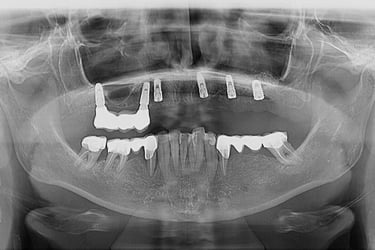 Sinus lift extern + inserare implanturi