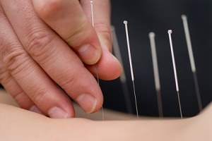 Acupuncture in Temecula California