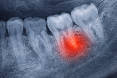 Emergency dentist in Greenville SC