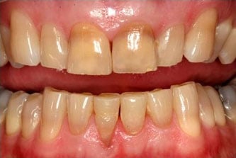 teeth staining greenville SC