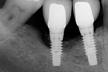 Image radiographique d'implants dentaires