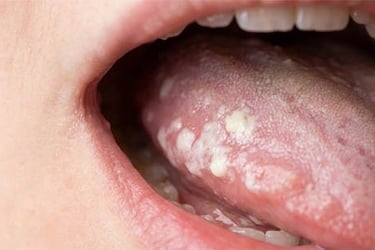 Stomatite Candidosique hygiene-precision.com