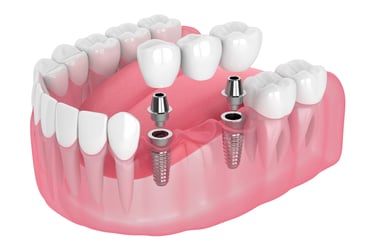 dental implant bridge