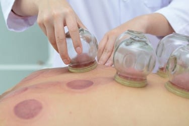 cupping therapy ou ventouses