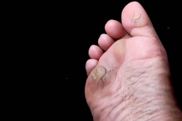 Ayak Kangreni Nedir? Belirtileri, Nedenleri ve Tedavi Seçenekleri
