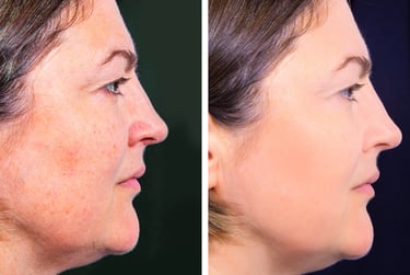 Botox Before and After