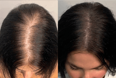 Best Scalp Micropigmentation Toronto_ATRUBARBER