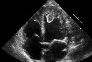 Echocardiogram showing LV clot for training in our hands-on cardiac ultrasound course.