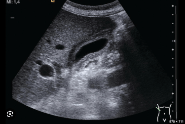Ultrasound imge of the gallbladder showing thick walls.
