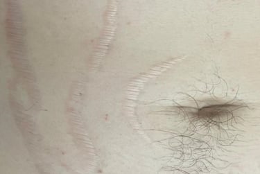healed belly scars