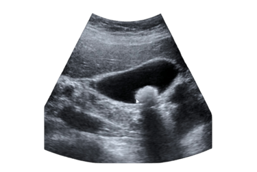 Ultrassom de abdome com cálculo na vesícula biliar