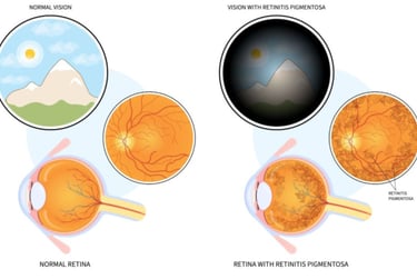retinitis-pigmentosa