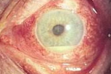 ماذا تعرف عن اسباب وتشخيص وعلاجات مرض بهجت