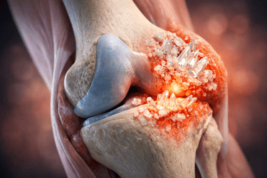 Figura 1 — Depósito de cristais de urato em articulação (Render 3D; imagem gerada pelo Nutro AI).