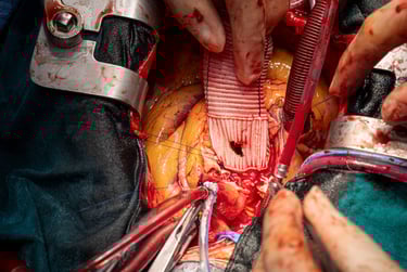 Aortic Aneurysm surgery in Malta