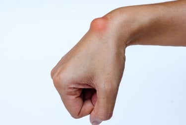 Wrist ganglion and digital mucous cyst treatments.