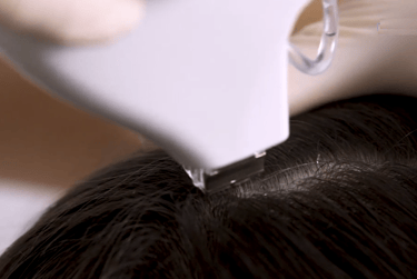Mesoterapia capilar
