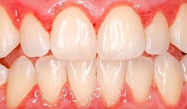 inflammation gencives gingivite