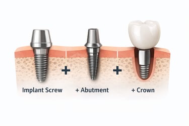 dental Implant cost 