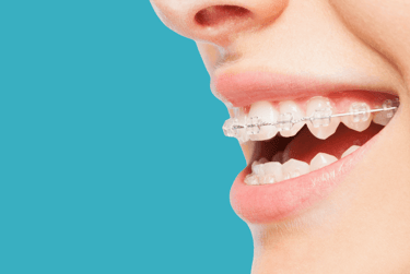 clear braces fitting