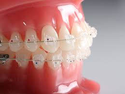 ceramic or tooth coloured braces