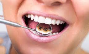 Lingual braces