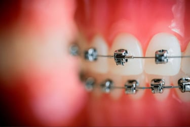 Metal Self Ligation braces