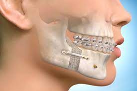 Orthognatic Surgery