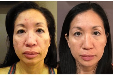 Before and after of woman skin clearer 