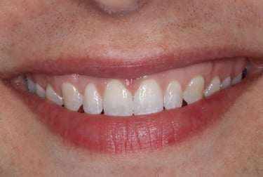 a close up of a person's teeth after invisalign aligner treatment
