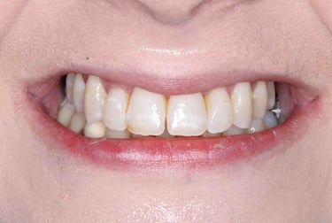 a close up of a person's teeth after invisalign aligner treatment