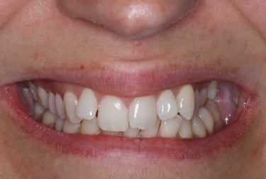 a close up of a person's mouth with mis aligned teeth