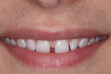 a close up of a person's mouth with mis aligned teeth