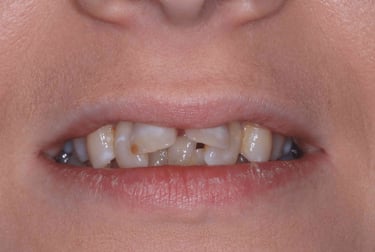 a close up of a person's mouth with mis aligned teeth