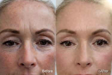 Skintastic 20% Argireline Line Busting Face Serum before and after results Australia – visibly reduc