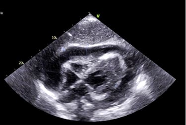 Ultrasound image showing tamponade in our hands-on POCUS training class.