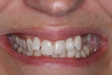 a close up of a person's mouth with mis aligned teeth
