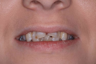 a close up of a person's mouth with mis aligned teeth