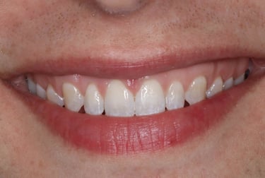 a close up of a person's teeth after invisalign aligner treatment