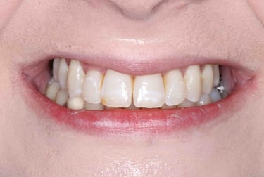 a close up of a person's teeth after invisalign aligner treatment