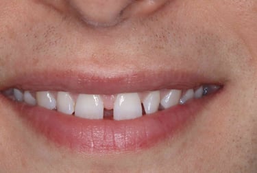 a close up of a person's mouth with mis aligned teeth