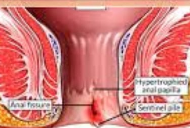 Anal fissures