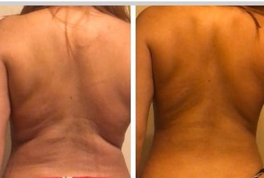 Cryolipolyse avant apres