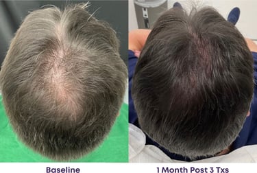 less bald spots after 3 treatments, fuller thicker hair