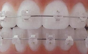 ceramic self ligation braces