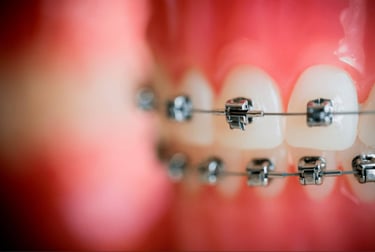 Metal Self Ligation braces