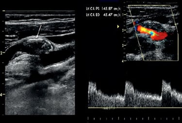 Duplex carotid ultrasound image showing vascular stenosis.