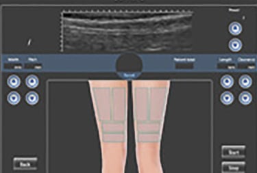 Traitement HIFU arrière des cuisses